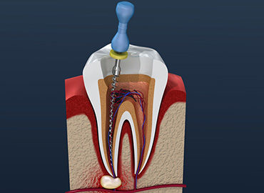 https://www.emtdent.com/wp-content/uploads/2020/12/endodontik-370x270.jpg